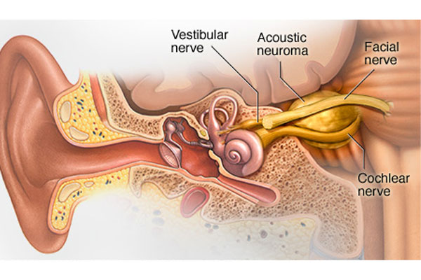 تومورها یا آسیب‌های وارده به سر از علل کم شنوایی