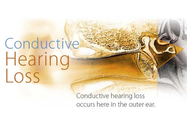 کم شنوایی انتقالی