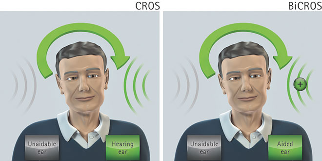 سمعک های CROS و BICROS