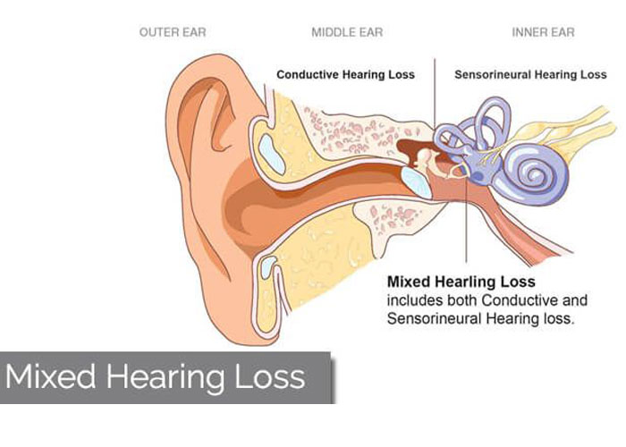کم شنوایی آمیخته چیست و روش درمان آن چگونه است؟