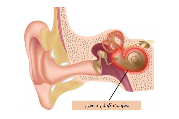 گرفتگی گوش به علت لابیرنتیت (Labyrinthitis)