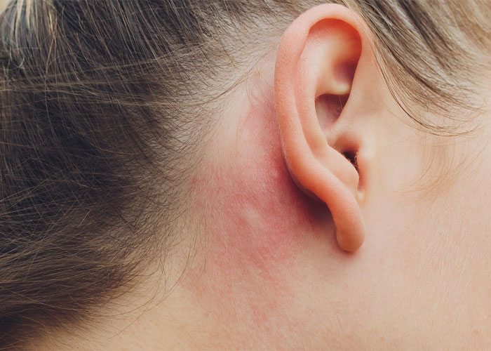 علائم، علت و روش درمان اگزمای گوش چیست