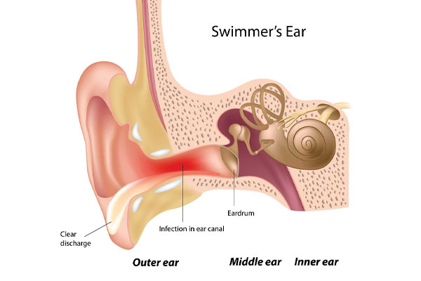 عفونت گوش خارجی چیست ؟